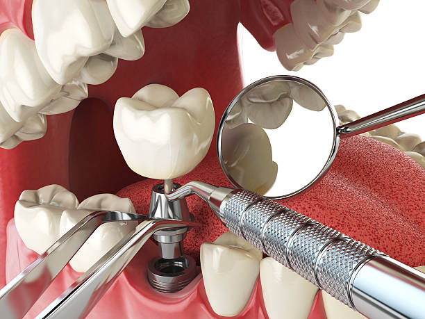 Best Chipped Tooth Repair Near Me  in Berea, SC